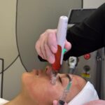 Microneedling