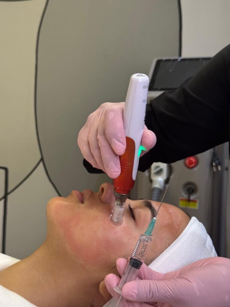 Microneedling