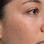 Peeling
