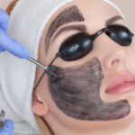 Carbon peel
