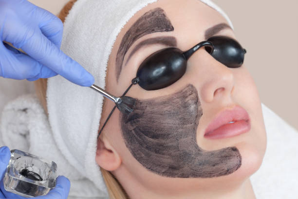 Carbon peel