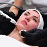 Microneedling