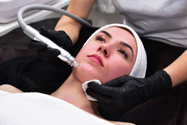Microneedling