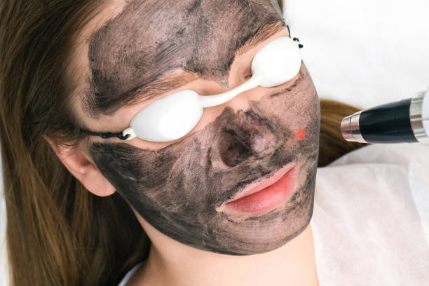 Carbon peel