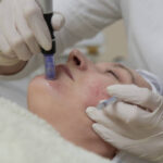 Microneedling