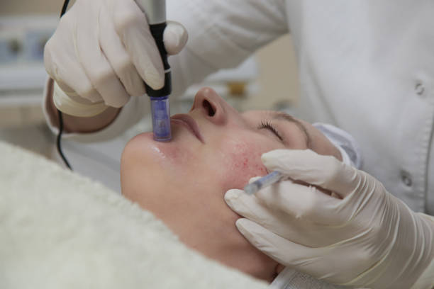 Microneedling