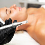 Microneedling