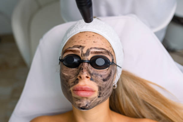 Carbon peel