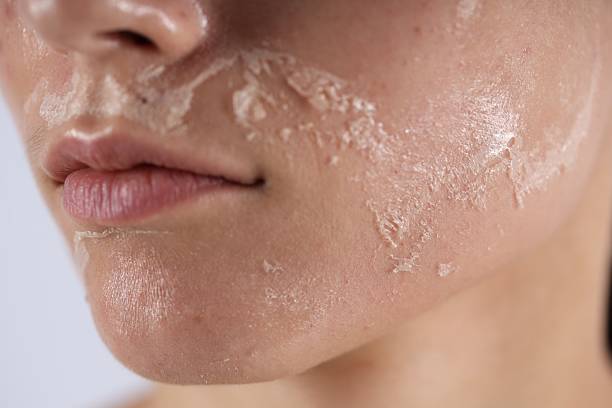 Peeling