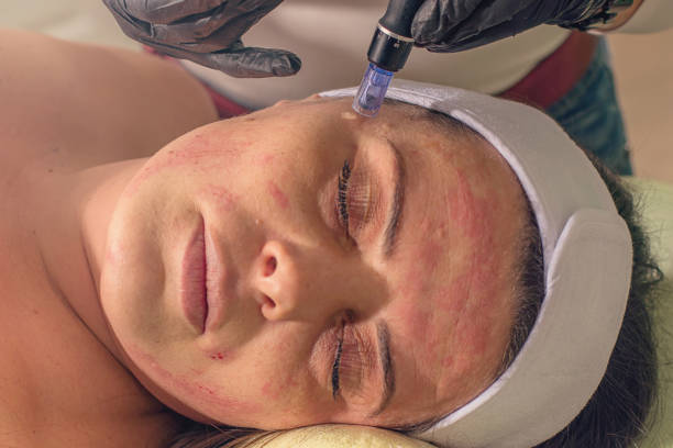 Microneedling